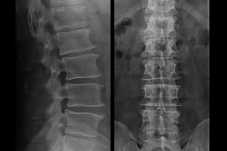 osteochondrosis röntgenfelvételen