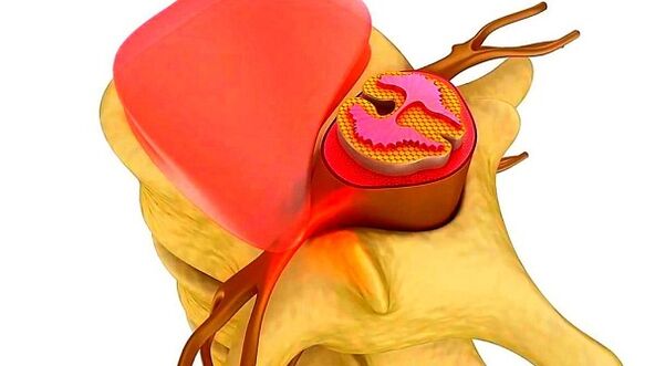 A mellkasi gerinc osteochondrosis a betegség lényege