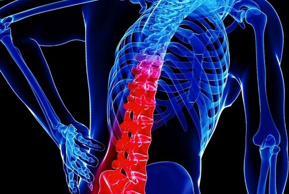 A mellkasi osteochondrosis kialakulásának okai