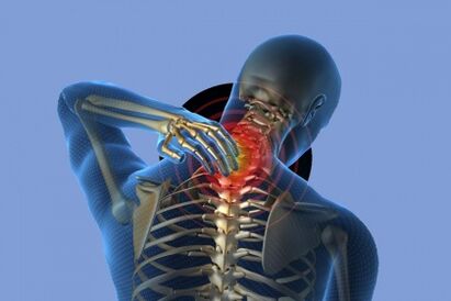 A nyaki fájdalom osteochondrosissal